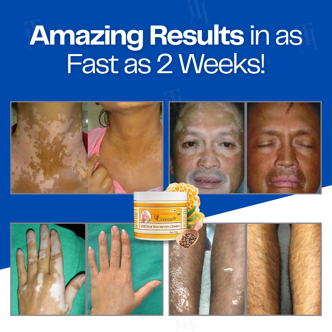 LAST 44 PCS LEFT!! Cvreoz® VitiClear Bee Venom Cream