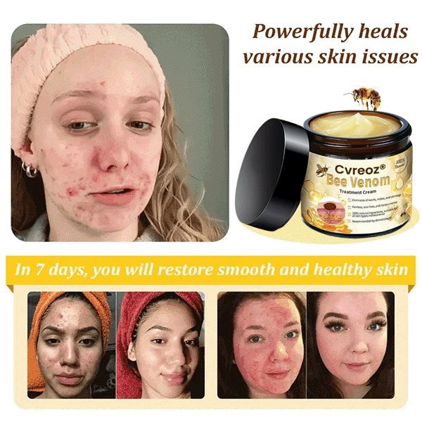 Cvreoz® Bee Venom Skin Treatment Cream (𝟟𝟘% 𝕆𝔽𝔽 𝗘𝗡𝗗𝗦 𝗜𝗡 𝟭𝟬 𝗠𝗜𝗡𝗨𝗧𝗘𝗦)