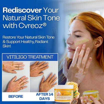 Cvreoz® VitiClear Bee Venom Cream  (𝟟𝟘% 𝕆𝔽𝔽 𝗘𝗡𝗗𝗦 𝗜𝗡 𝟭𝟬 𝗠𝗜𝗡𝗨𝗧𝗘𝗦)