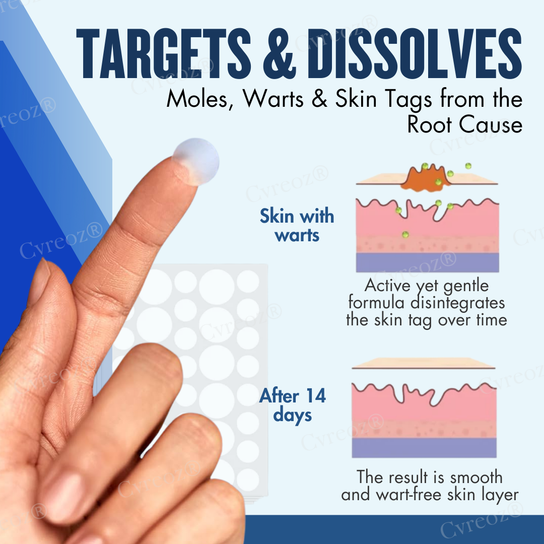 Cvreoz® Moles & Warts Removing Skin Tag Patch (𝟟𝟘% 𝕆𝔽𝔽 𝗘𝗡𝗗𝗦 𝗜𝗡 𝟭𝟬 𝗠𝗜𝗡𝗨𝗧𝗘𝗦)