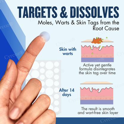 Cvreoz® Moles & Warts Removing Skin Tag Patch (𝟟𝟘% 𝕆𝔽𝔽 𝗘𝗡𝗗𝗦 𝗜𝗡 𝟭𝟬 𝗠𝗜𝗡𝗨𝗧𝗘𝗦)