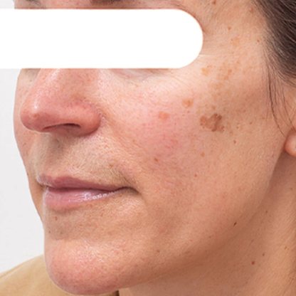 AEXZR® Herbal Spots Peel-Off Facial Mask  (𝟟𝟘% 𝕆𝔽𝔽 𝗘𝗡𝗗𝗦 𝗜𝗡 𝟭𝟬 𝗠𝗜𝗡𝗨𝗧𝗘𝗦)