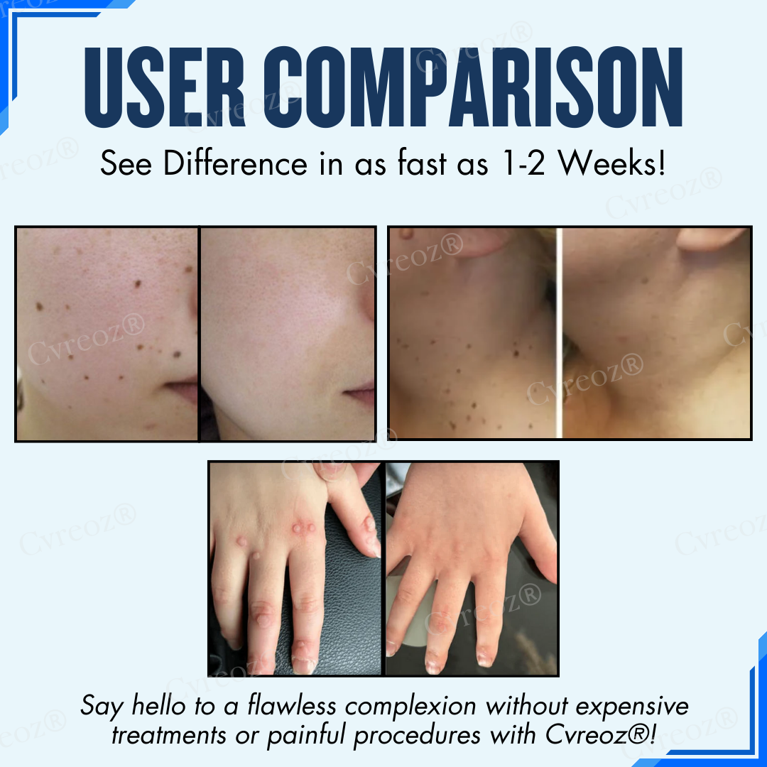 Cvreoz® Moles & Warts Removing Skin Tag Patch (𝟟𝟘% 𝕆𝔽𝔽 𝗘𝗡𝗗𝗦 𝗜𝗡 𝟭𝟬 𝗠𝗜𝗡𝗨𝗧𝗘𝗦)