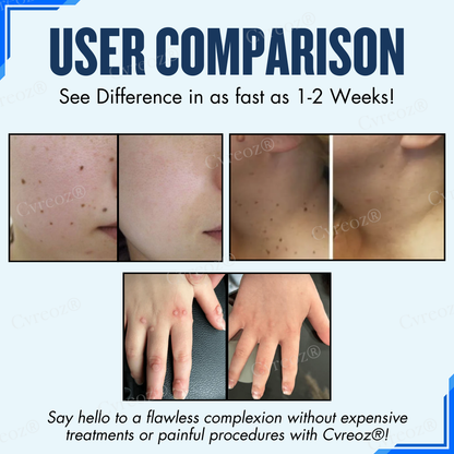 Cvreoz® Moles & Warts Removing Skin Tag Patch (𝟟𝟘% 𝕆𝔽𝔽 𝗘𝗡𝗗𝗦 𝗜𝗡 𝟭𝟬 𝗠𝗜𝗡𝗨𝗧𝗘𝗦)